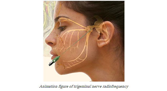 Animation figure of trigeminal nerve radiofrequency